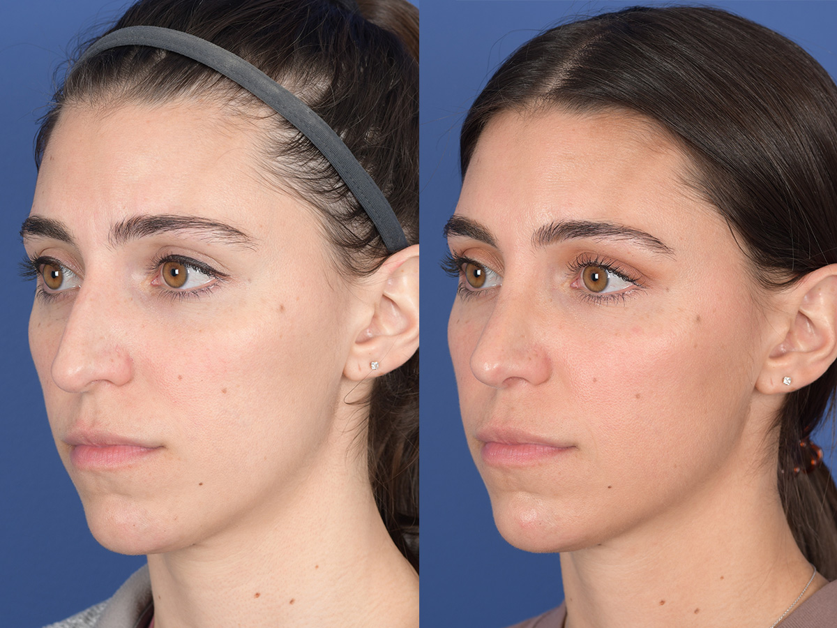 Rhinoplasty Before and After | Weber Facial Plastic Surgery