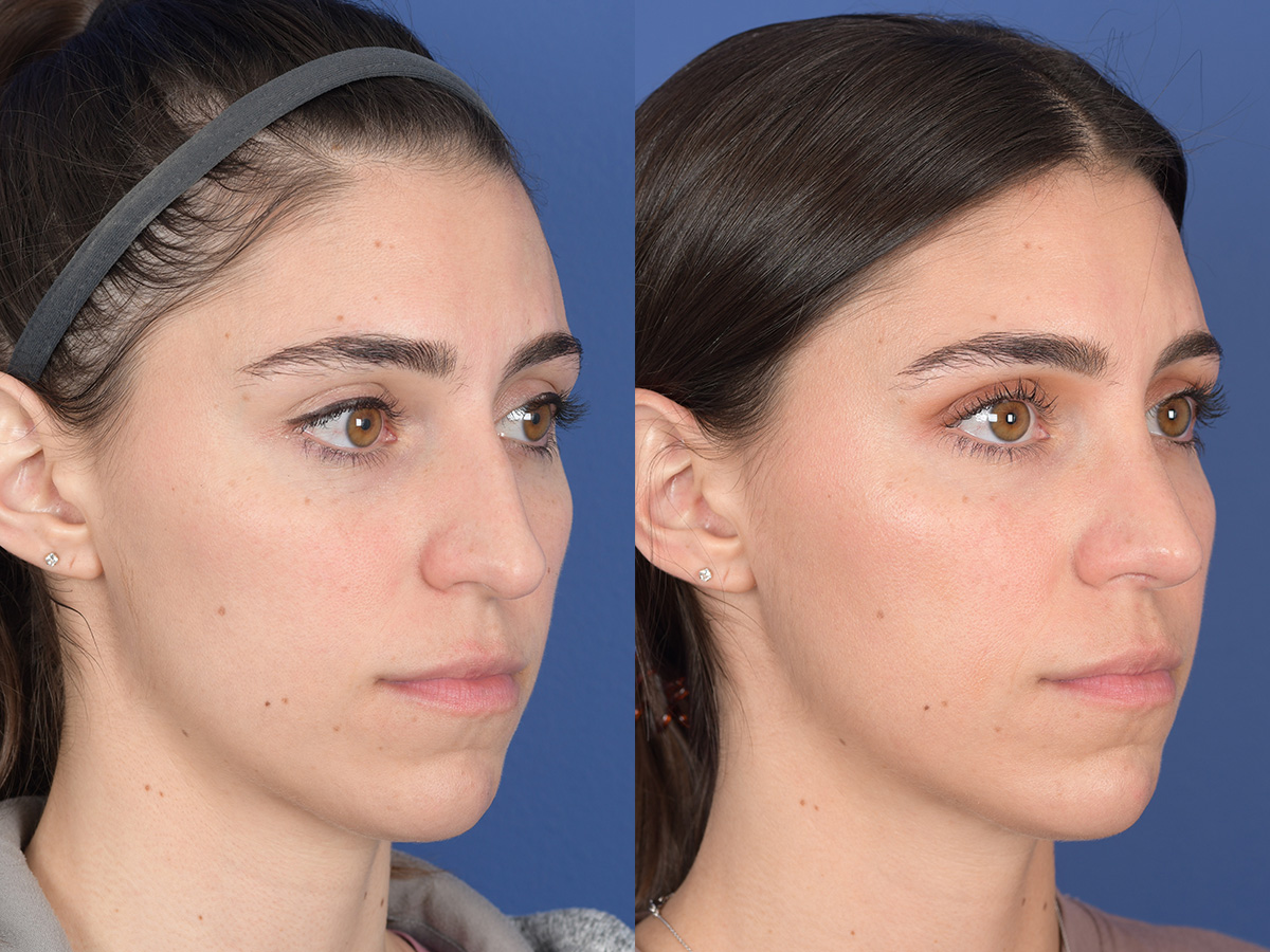 Rhinoplasty Before and After | Weber Facial Plastic Surgery