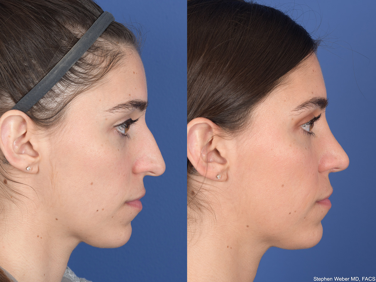 Rhinoplasty Before and After | Weber Facial Plastic Surgery