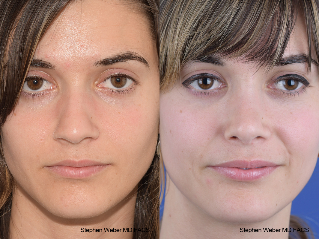 Rhinoplasty Before and After | Weber Facial Plastic Surgery