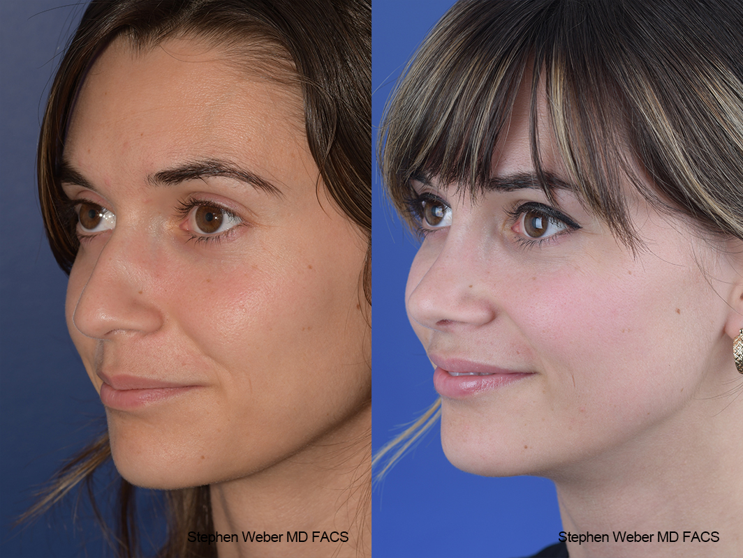 Rhinoplasty Before and After | Weber Facial Plastic Surgery