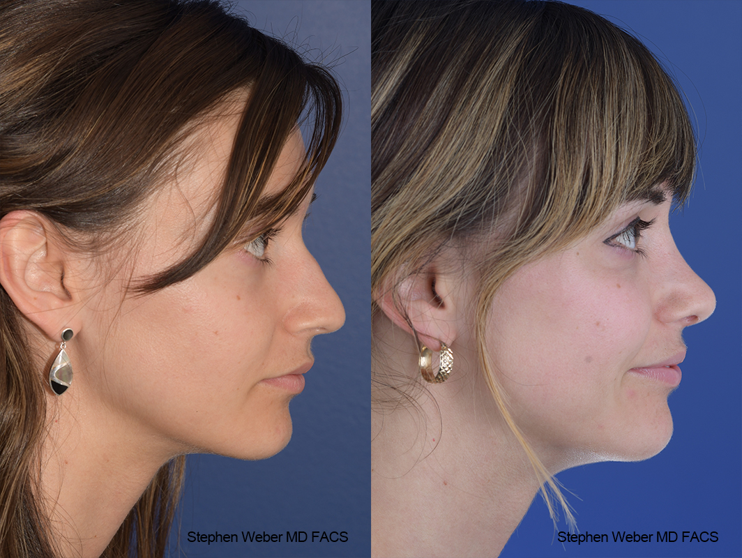 Rhinoplasty Before and After | Weber Facial Plastic Surgery