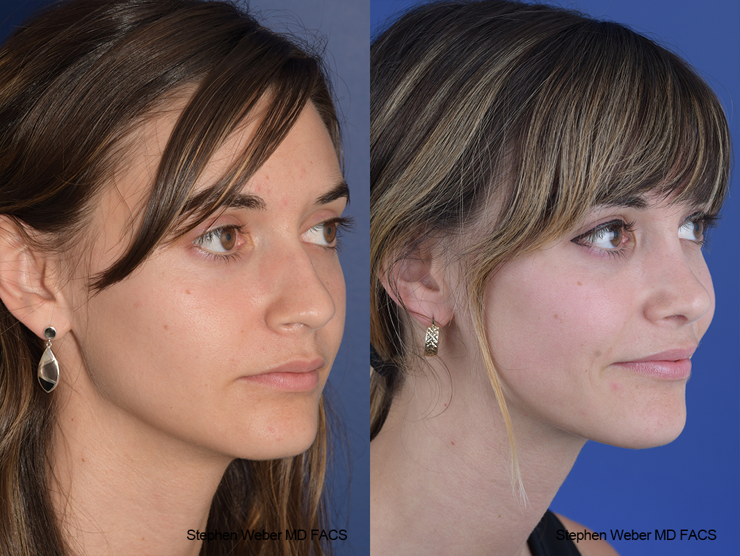 Rhinoplasty Before and After | Weber Facial Plastic Surgery