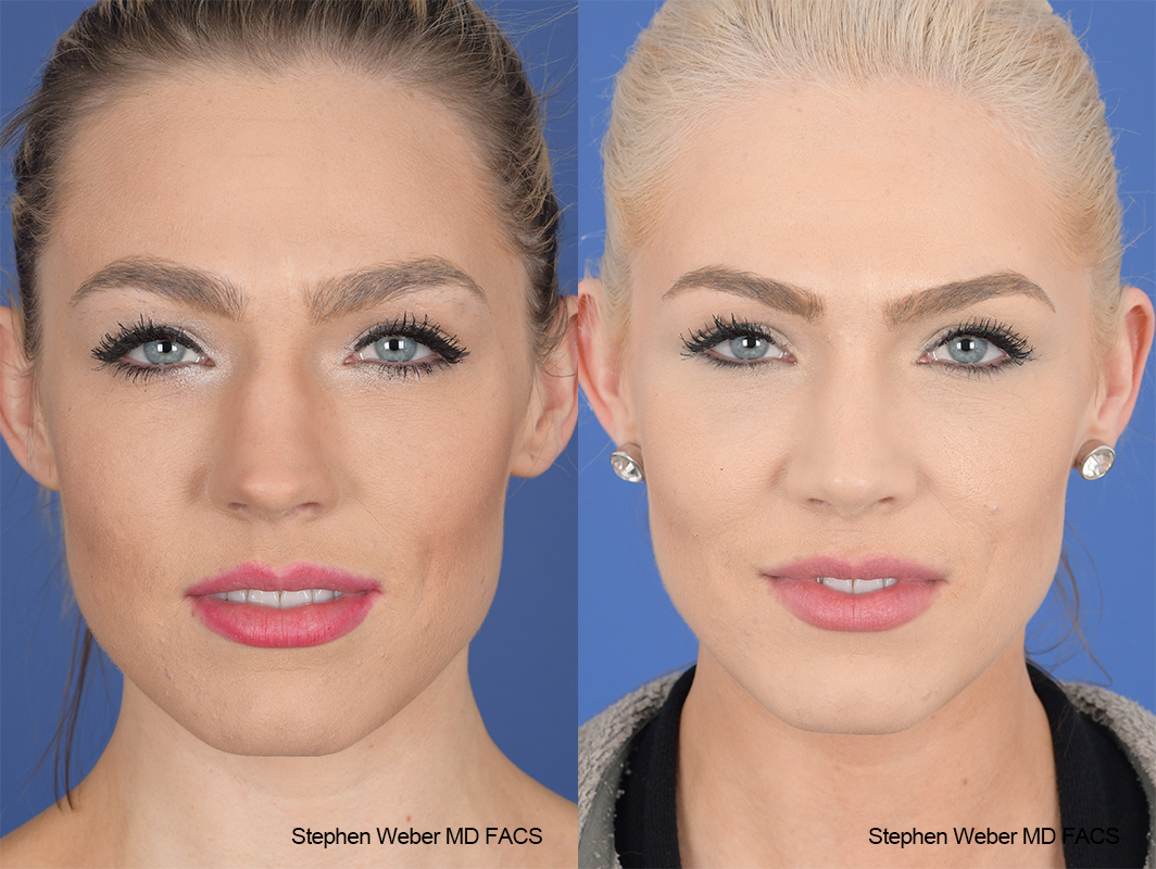 Rhinoplasty Before and After | Weber Facial Plastic Surgery