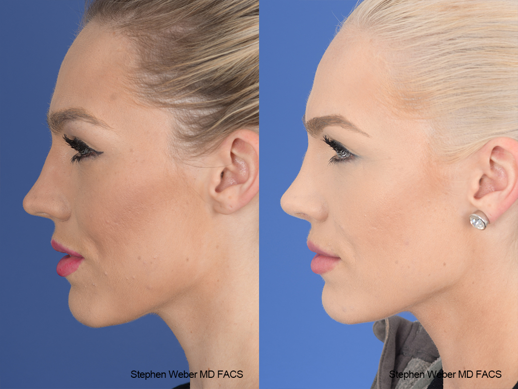 Rhinoplasty Before and After | Weber Facial Plastic Surgery