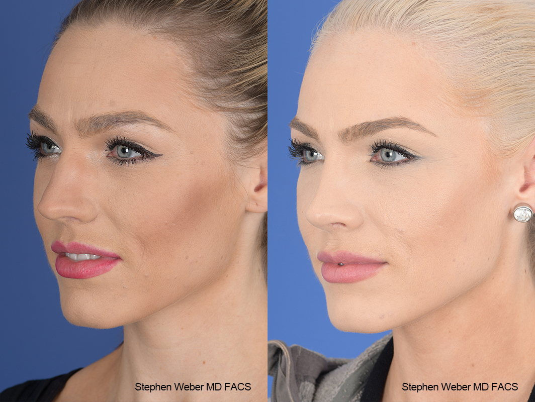 Rhinoplasty Before and After | Weber Facial Plastic Surgery