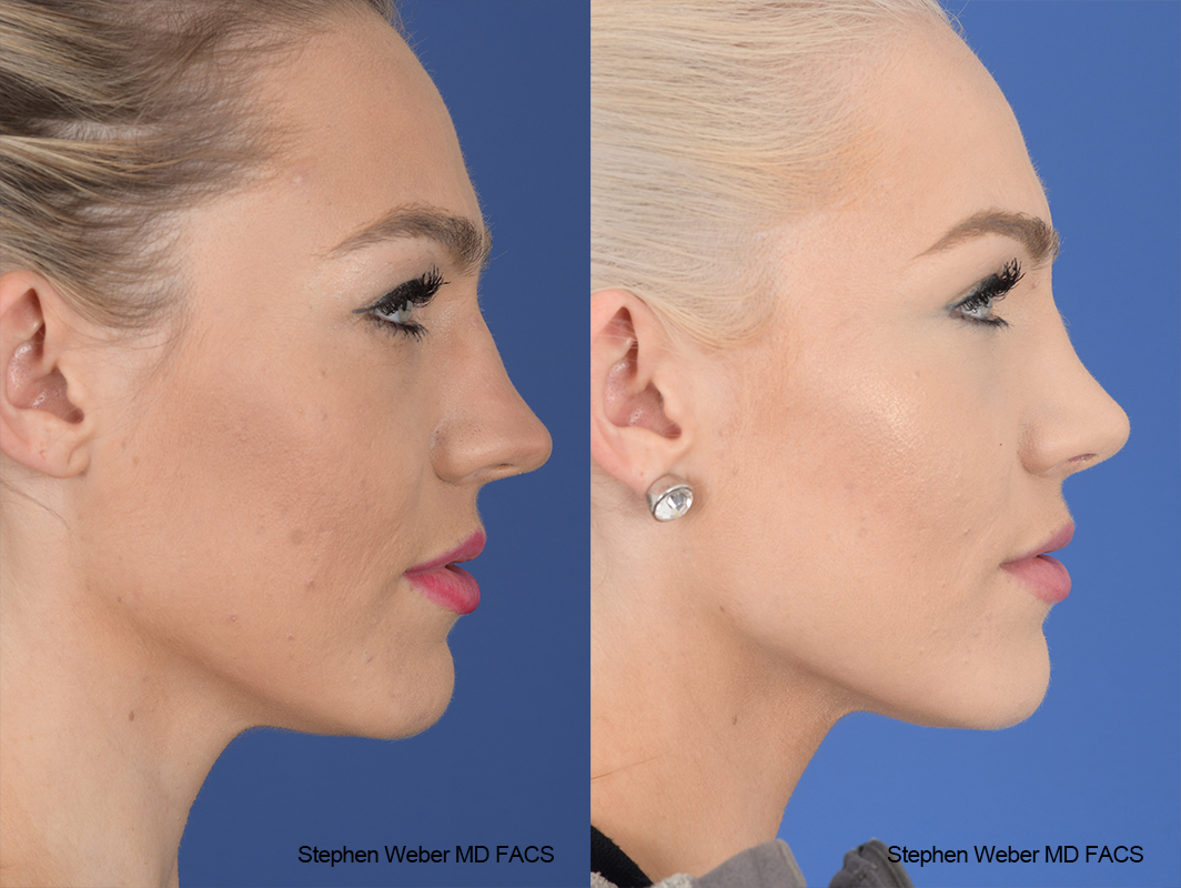 Rhinoplasty Before and After | Weber Facial Plastic Surgery