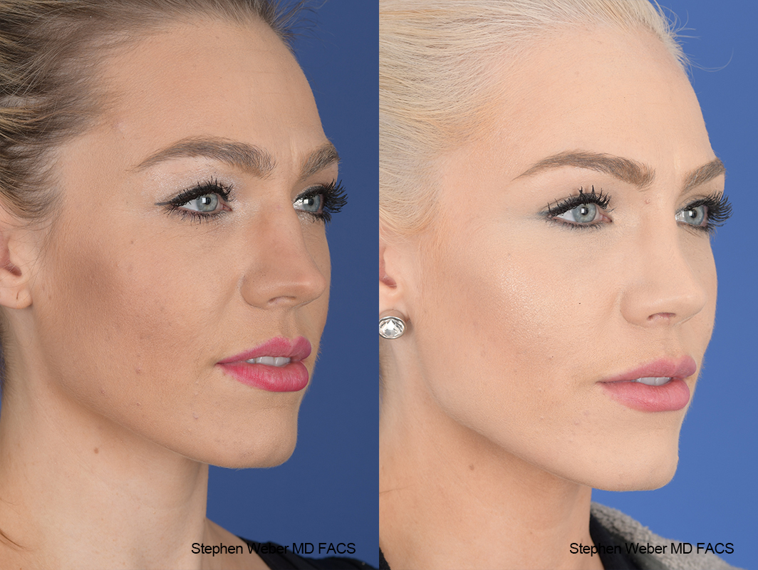 Rhinoplasty Before and After | Weber Facial Plastic Surgery