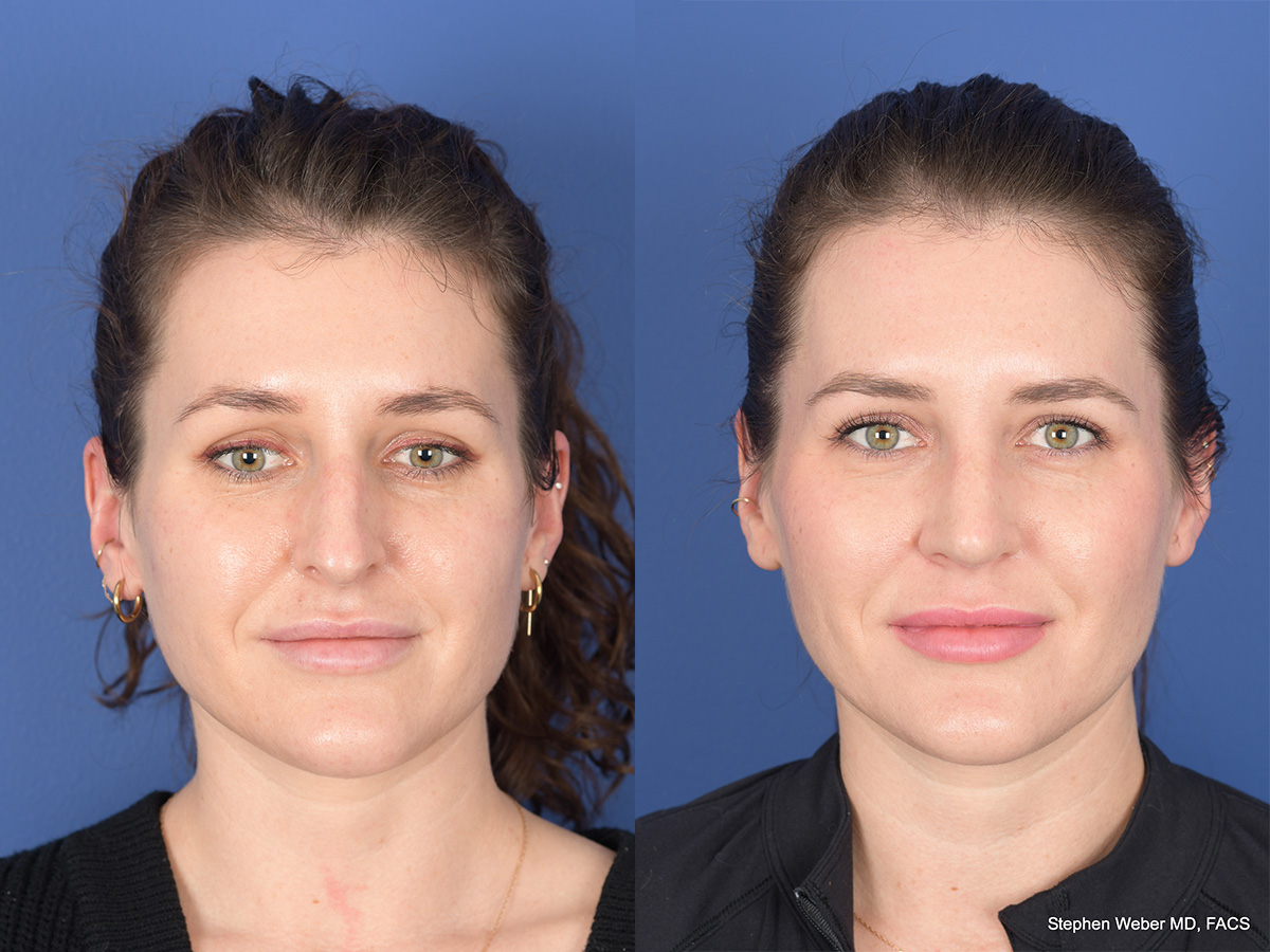 Rhinoplasty Before and After | Weber Facial Plastic Surgery