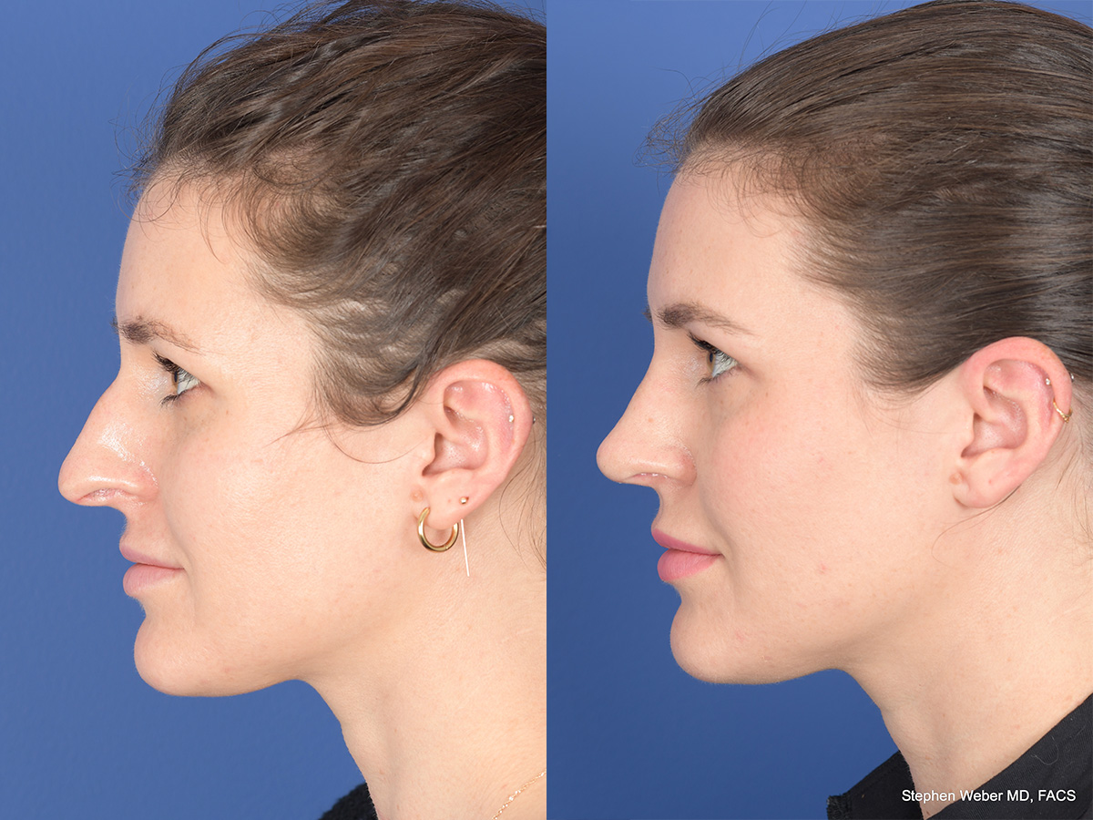 Rhinoplasty Before and After | Weber Facial Plastic Surgery