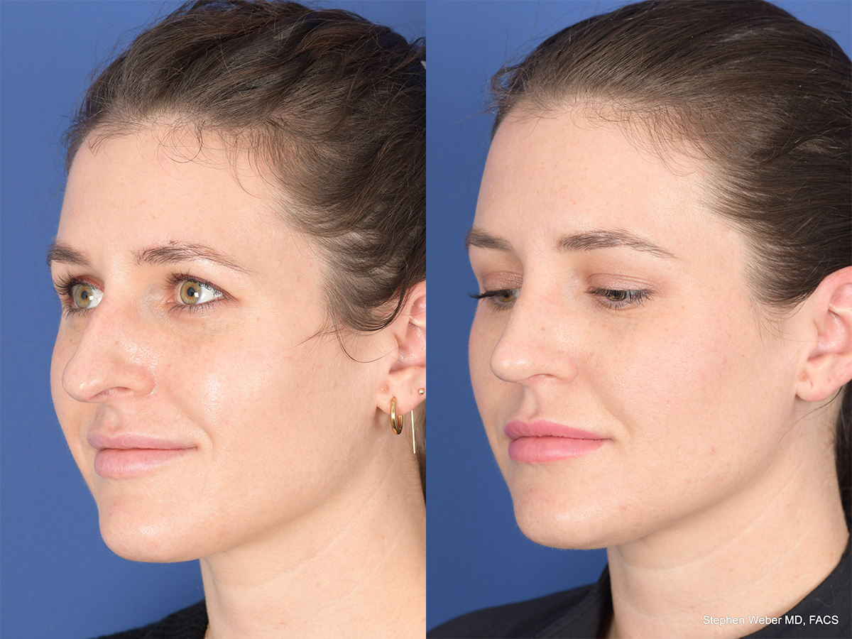 Rhinoplasty Before and After | Weber Facial Plastic Surgery
