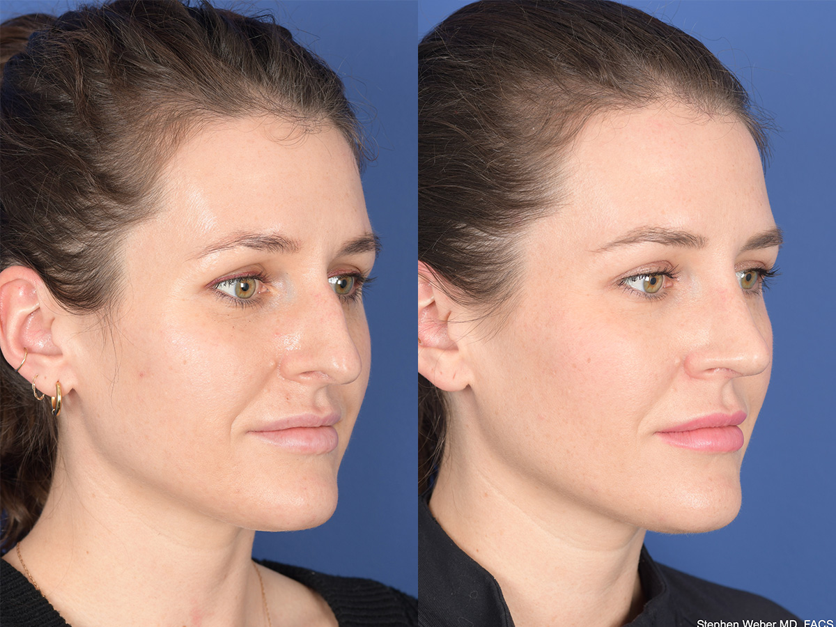 Rhinoplasty Before and After | Weber Facial Plastic Surgery