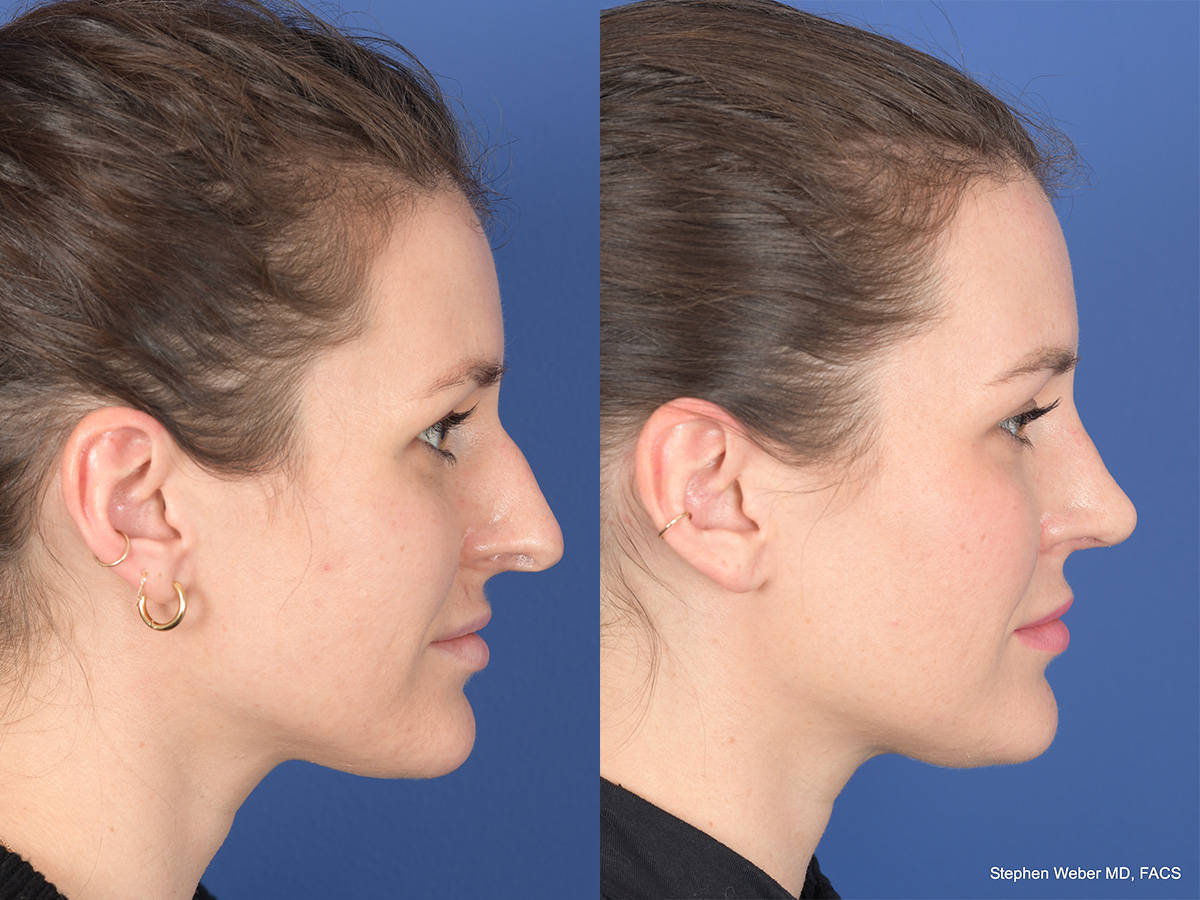 Rhinoplasty Before and After | Weber Facial Plastic Surgery