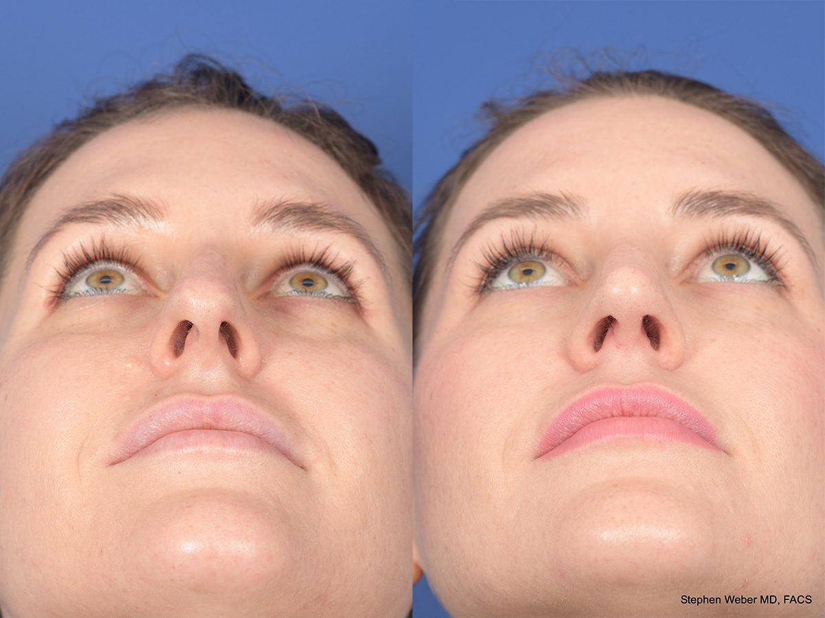 Rhinoplasty Before and After | Weber Facial Plastic Surgery