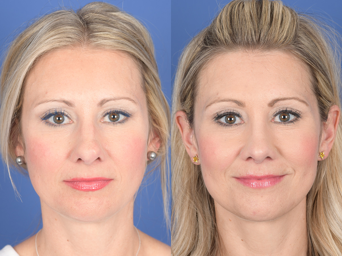 Rhinoplasty Before and After | Weber Facial Plastic Surgery