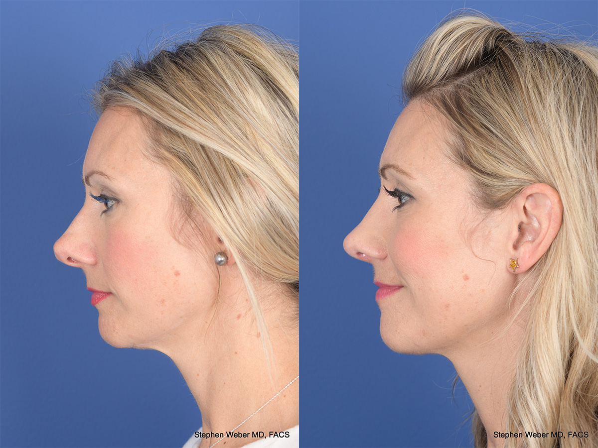 Rhinoplasty Before and After | Weber Facial Plastic Surgery
