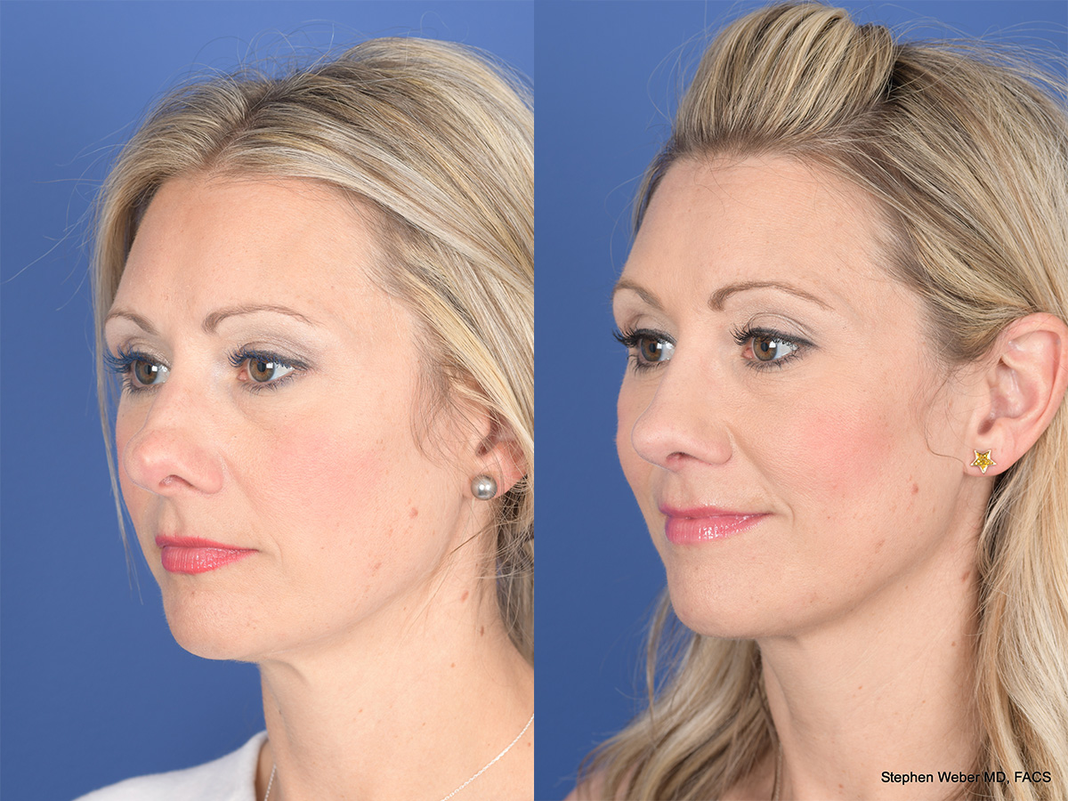 Rhinoplasty Before and After | Weber Facial Plastic Surgery