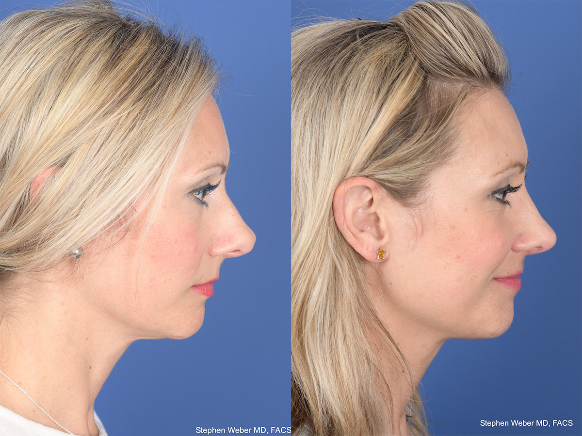 Rhinoplasty Before and After | Weber Facial Plastic Surgery