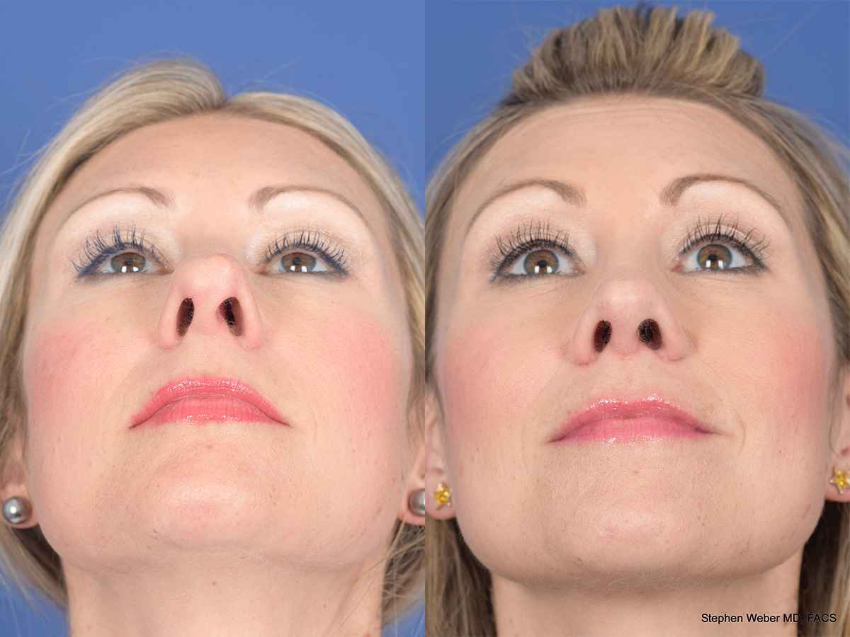 Rhinoplasty Before and After | Weber Facial Plastic Surgery