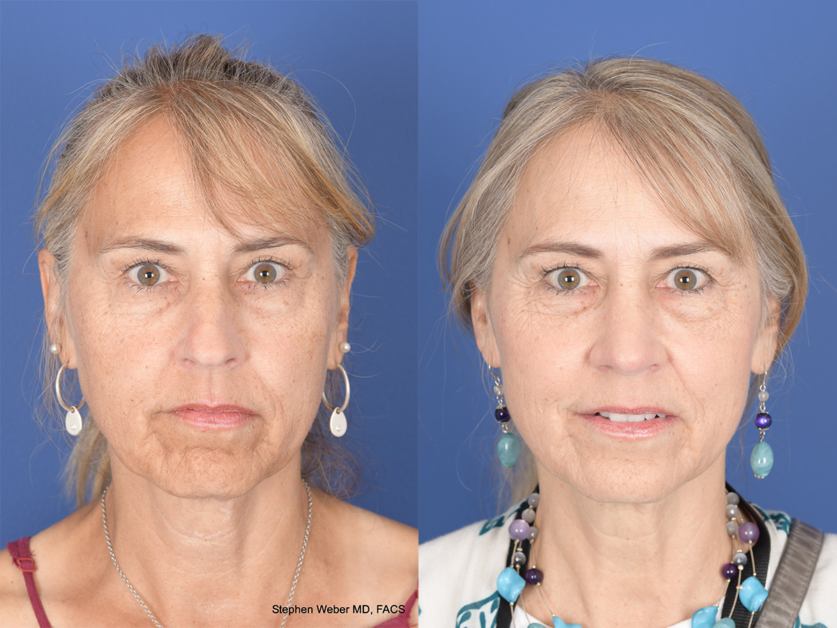Rhinoplasty Before and After | Weber Facial Plastic Surgery