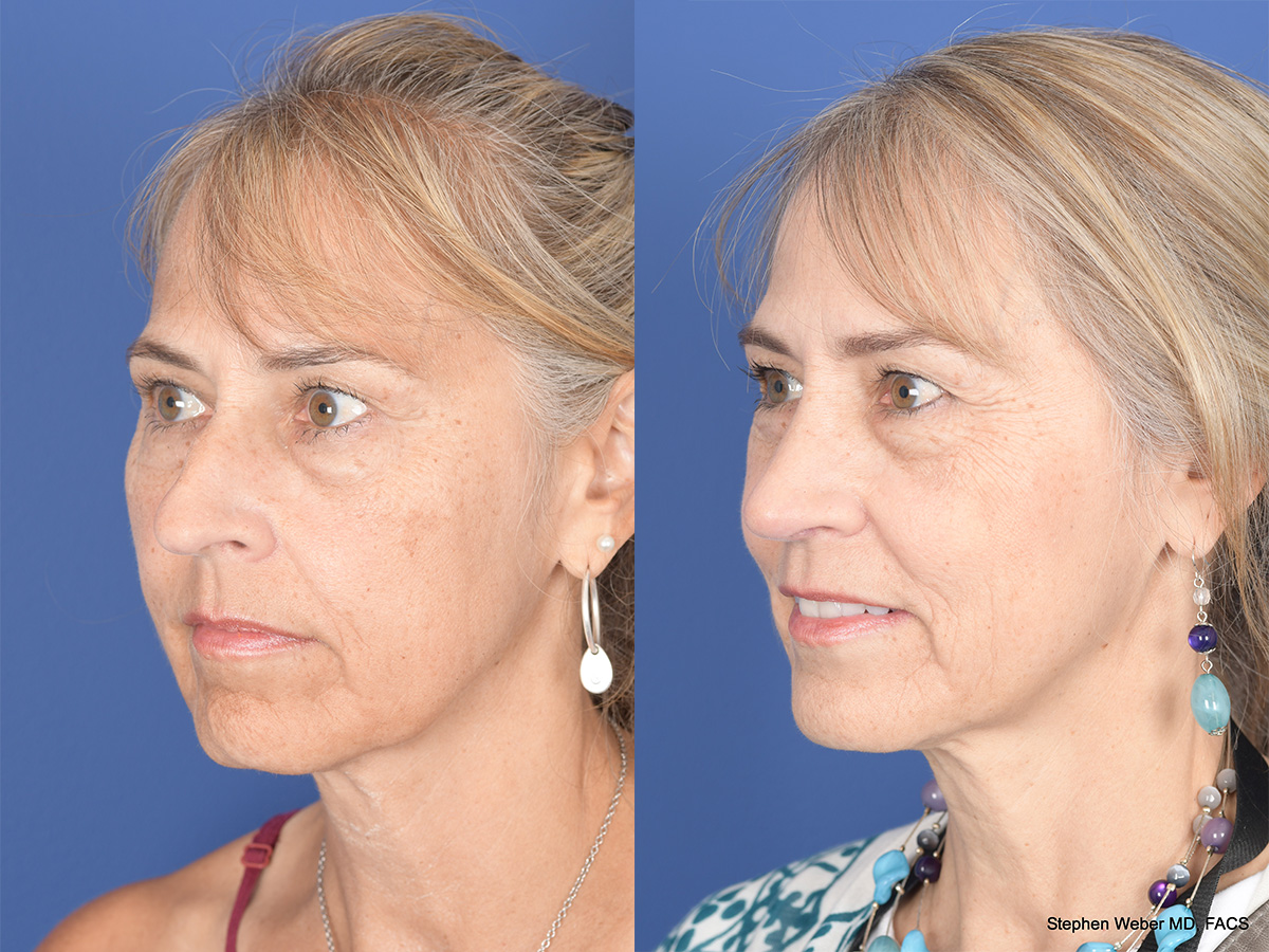 Rhinoplasty Before and After | Weber Facial Plastic Surgery