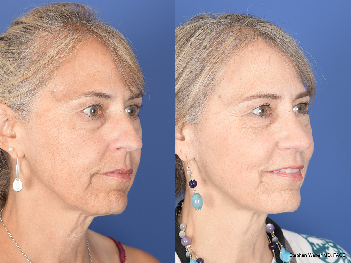 Rhinoplasty Before and After | Weber Facial Plastic Surgery