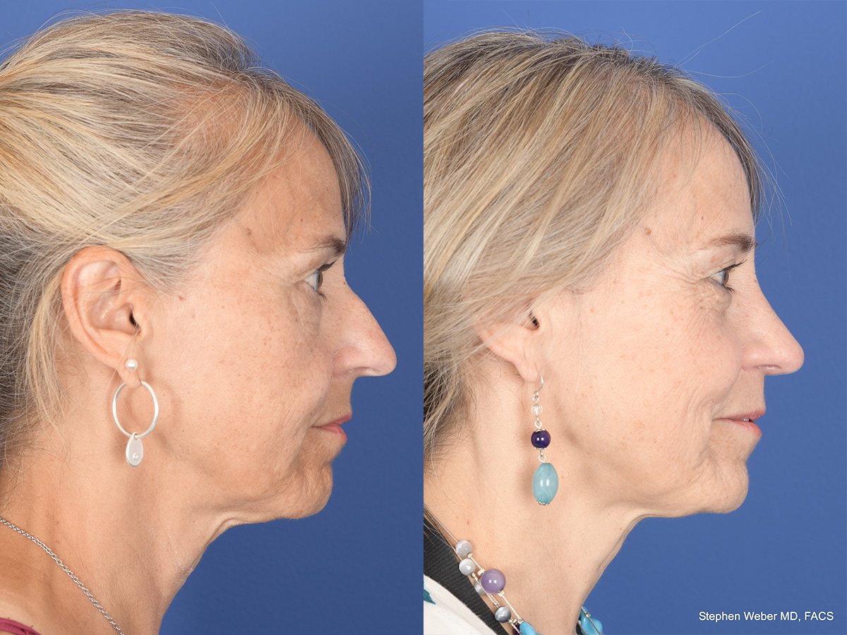 Rhinoplasty Before and After | Weber Facial Plastic Surgery
