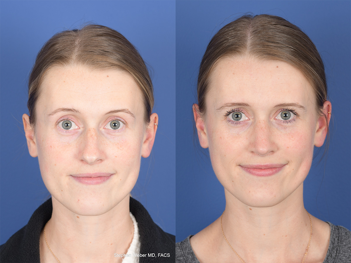 Rhinoplasty Before and After | Weber Facial Plastic Surgery