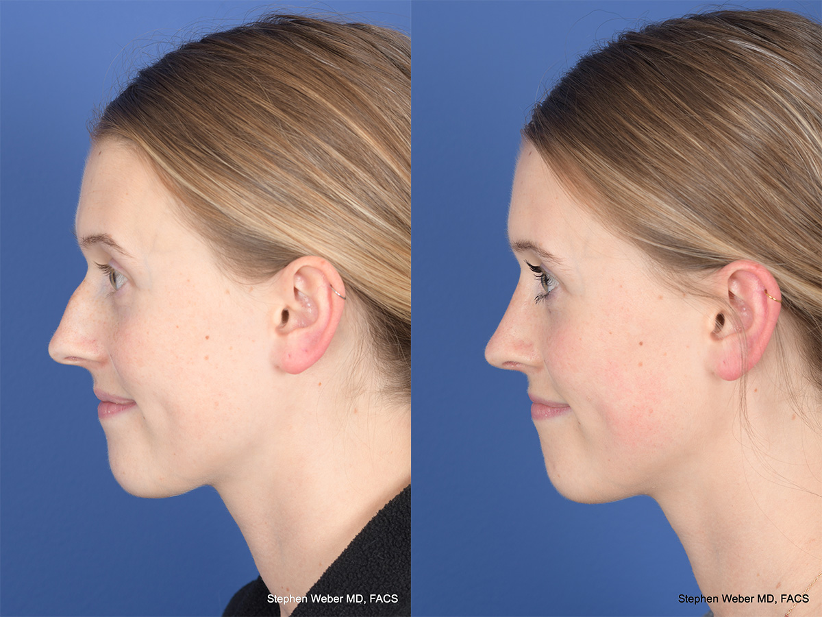 Rhinoplasty Before and After | Weber Facial Plastic Surgery