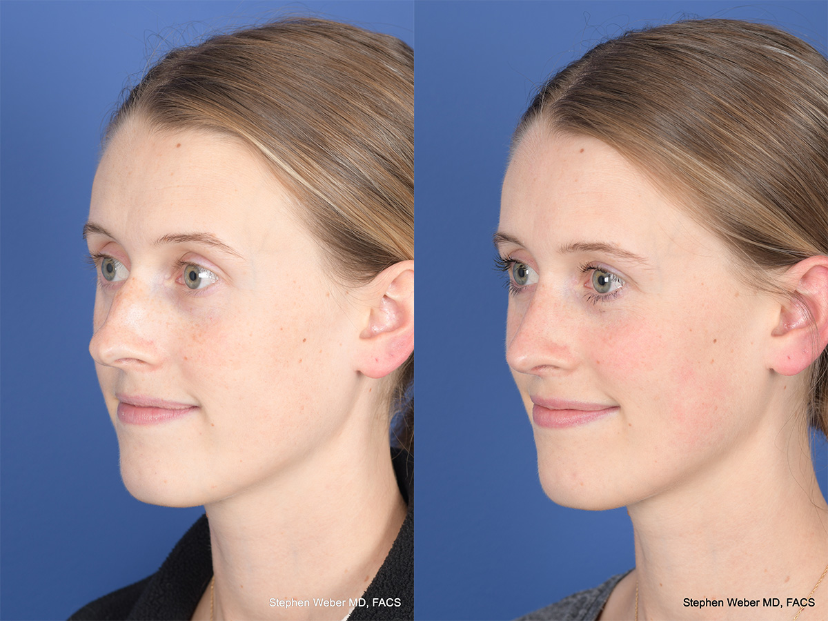 Rhinoplasty Before and After | Weber Facial Plastic Surgery