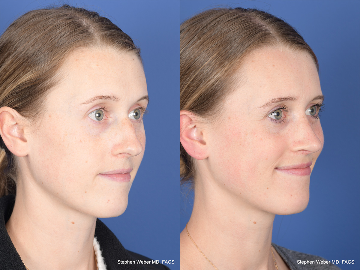 Rhinoplasty Before and After | Weber Facial Plastic Surgery