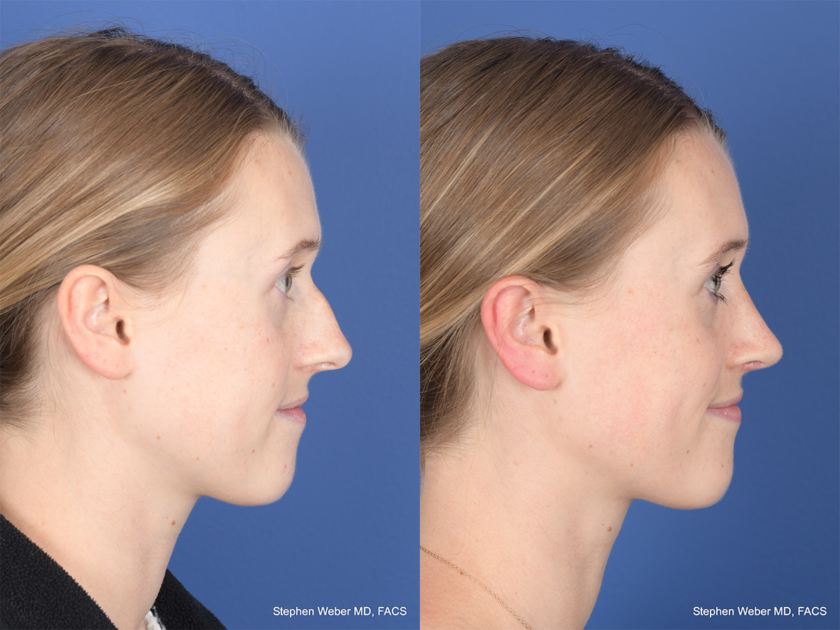 Rhinoplasty Before and After | Weber Facial Plastic Surgery