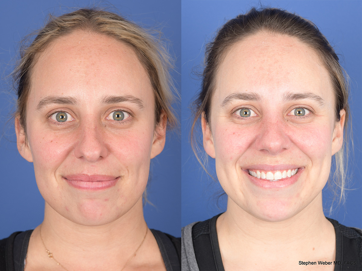 Rhinoplasty Before and After | Weber Facial Plastic Surgery