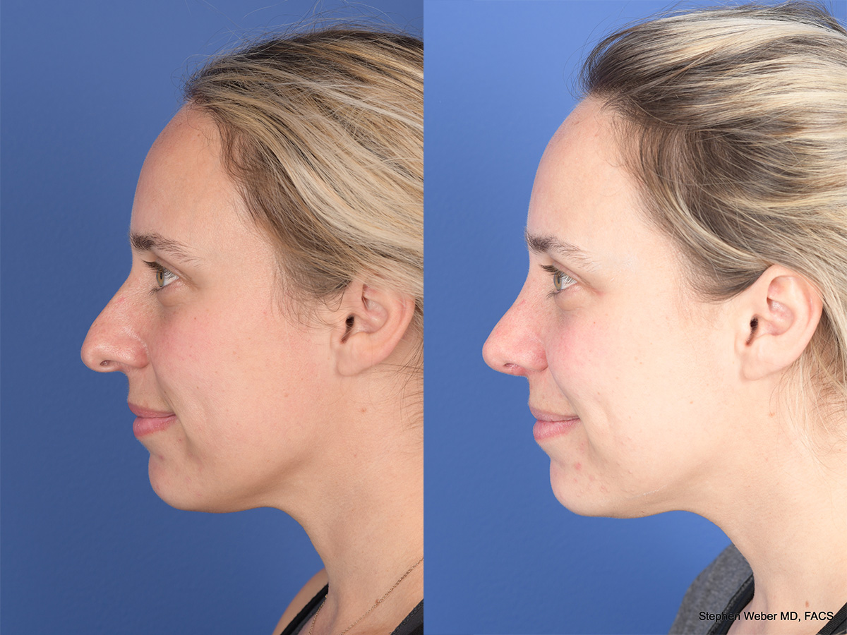 Rhinoplasty Before and After | Weber Facial Plastic Surgery