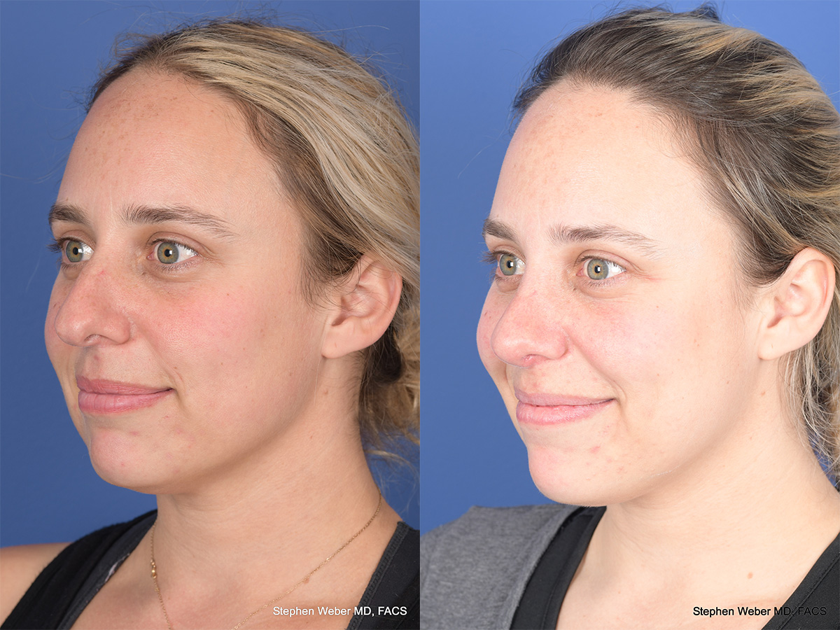 Rhinoplasty Before and After | Weber Facial Plastic Surgery