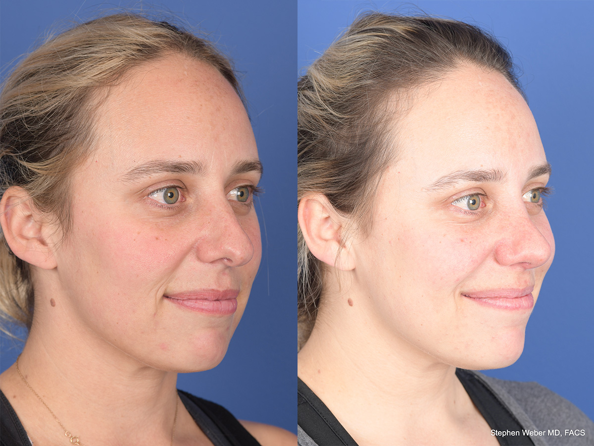 Rhinoplasty Before and After | Weber Facial Plastic Surgery