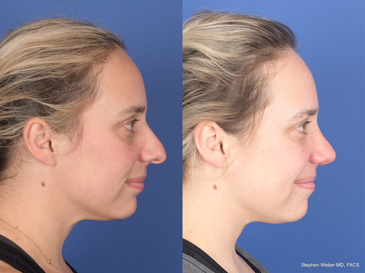 Rhinoplasty Before and After | Weber Facial Plastic Surgery