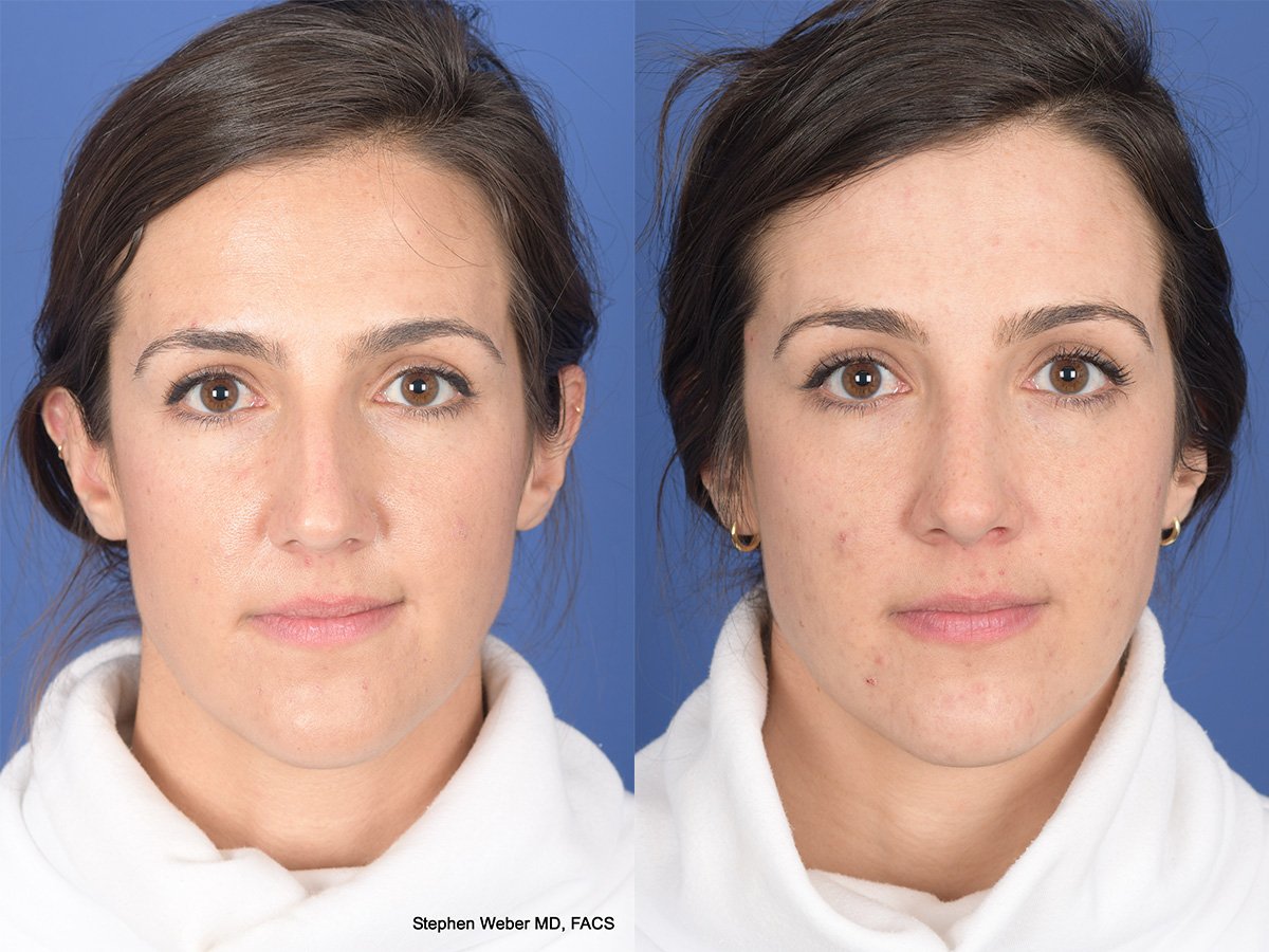 Rhinoplasty Before and After | Weber Facial Plastic Surgery