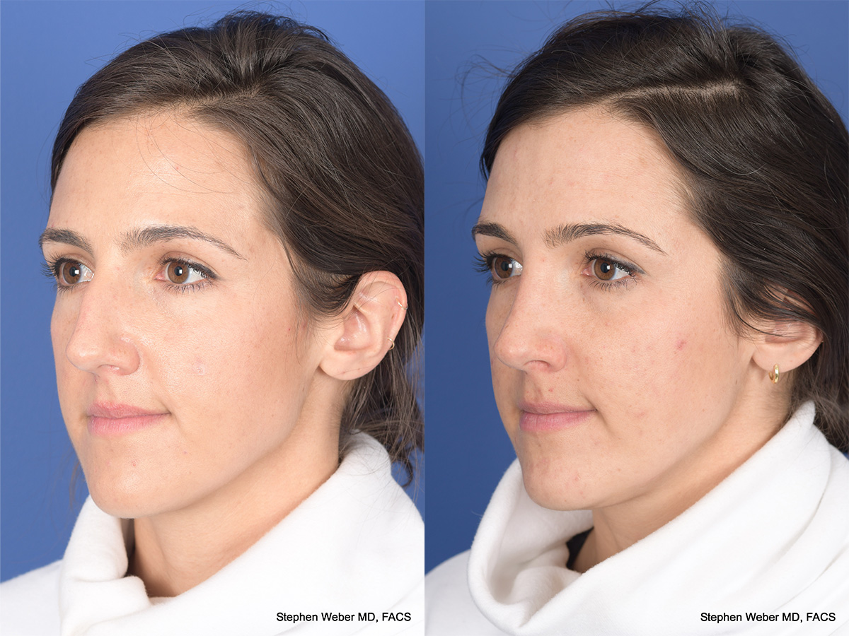 Rhinoplasty Before and After | Weber Facial Plastic Surgery