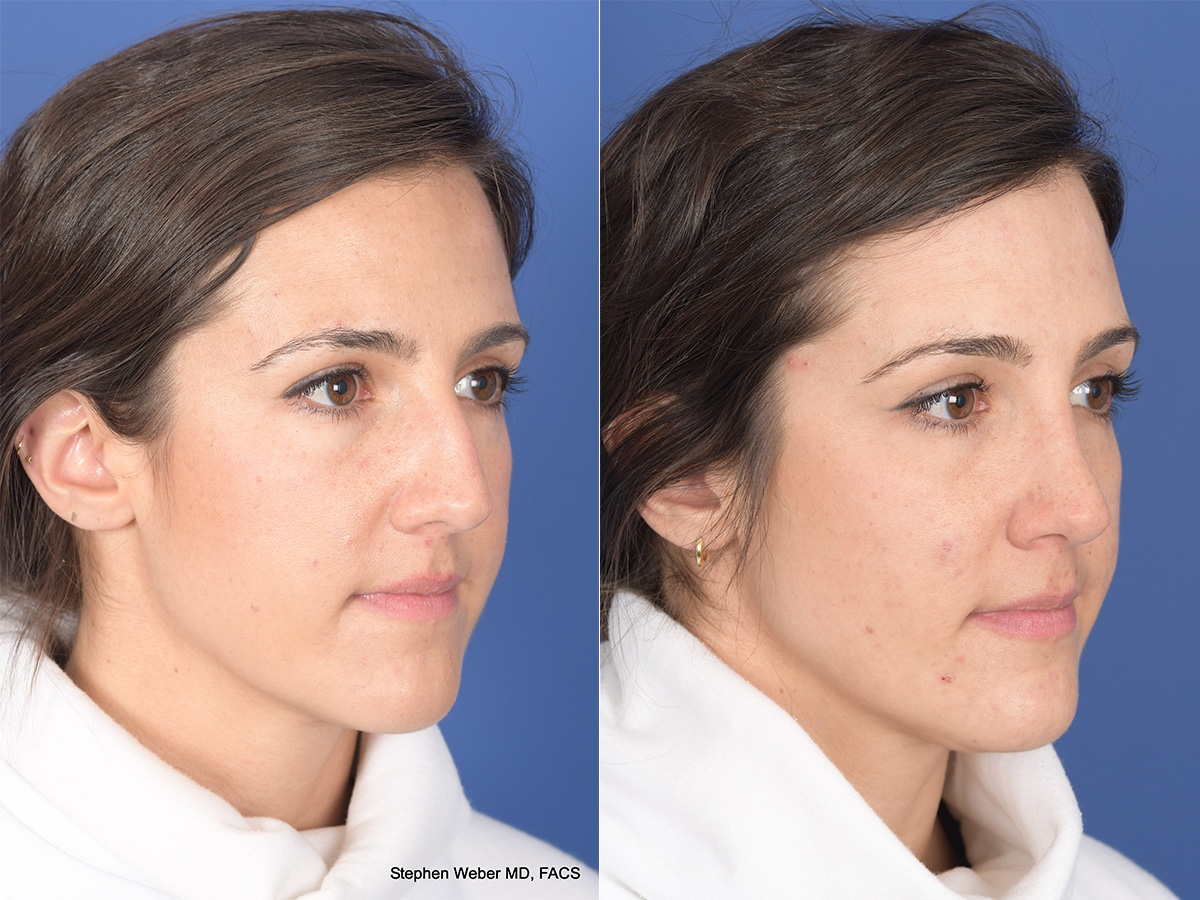 Rhinoplasty Before and After | Weber Facial Plastic Surgery