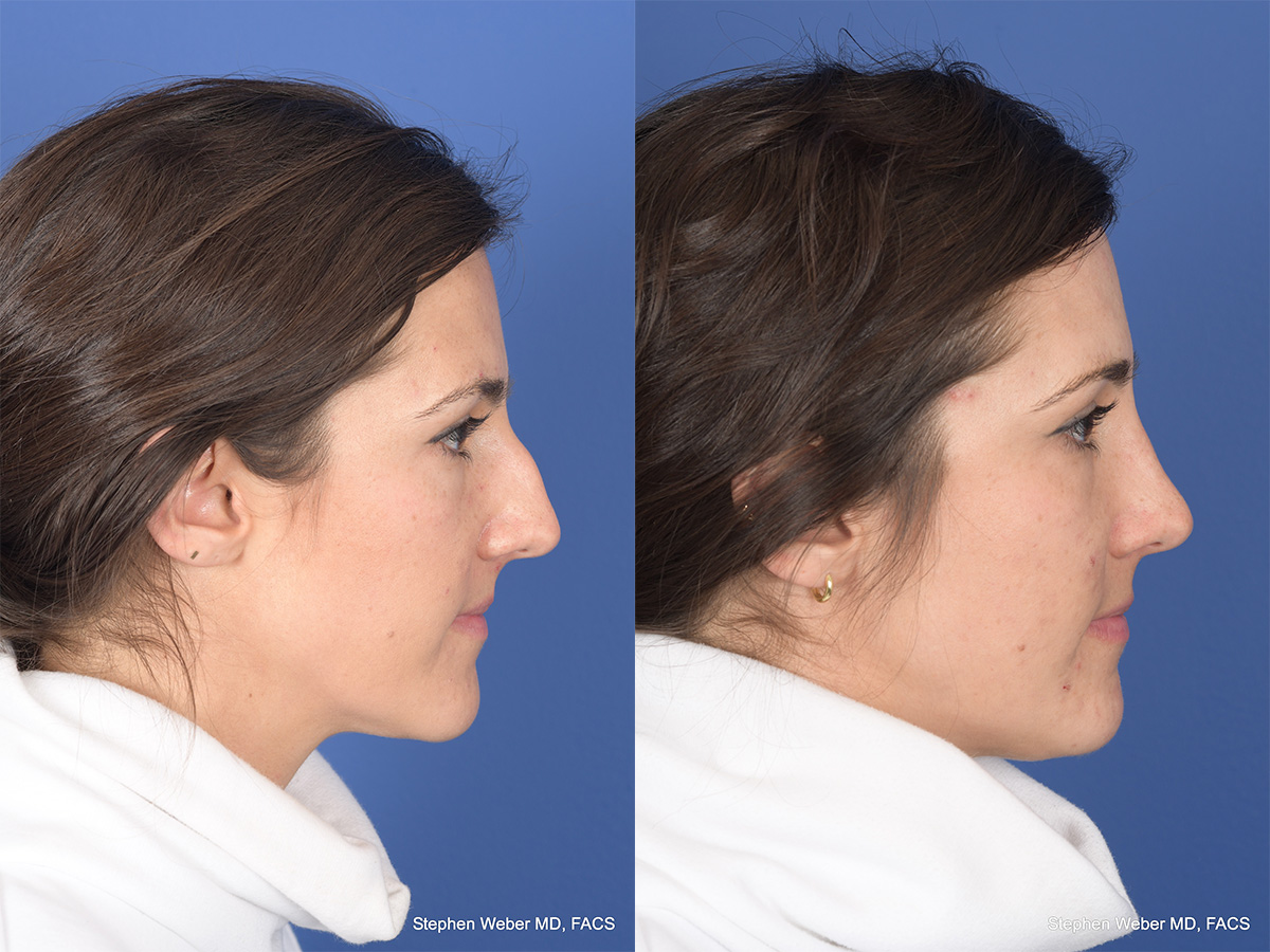Rhinoplasty Before and After | Weber Facial Plastic Surgery