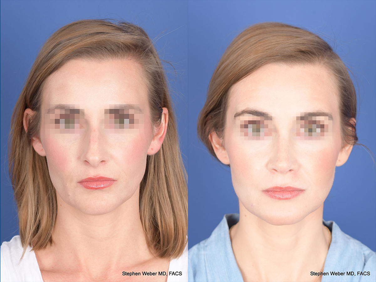 Rhinoplasty Before and After | Weber Facial Plastic Surgery