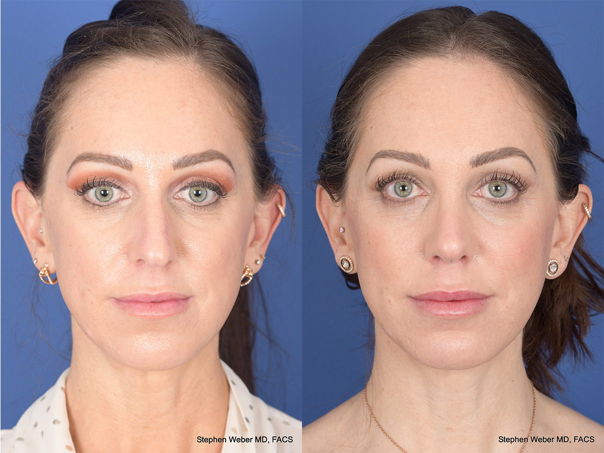 Rhinoplasty Before and After | Weber Facial Plastic Surgery