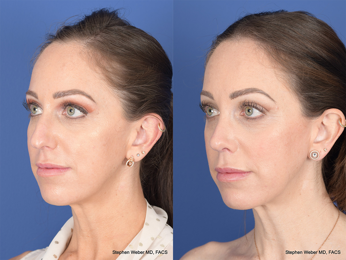 Rhinoplasty Before and After | Weber Facial Plastic Surgery