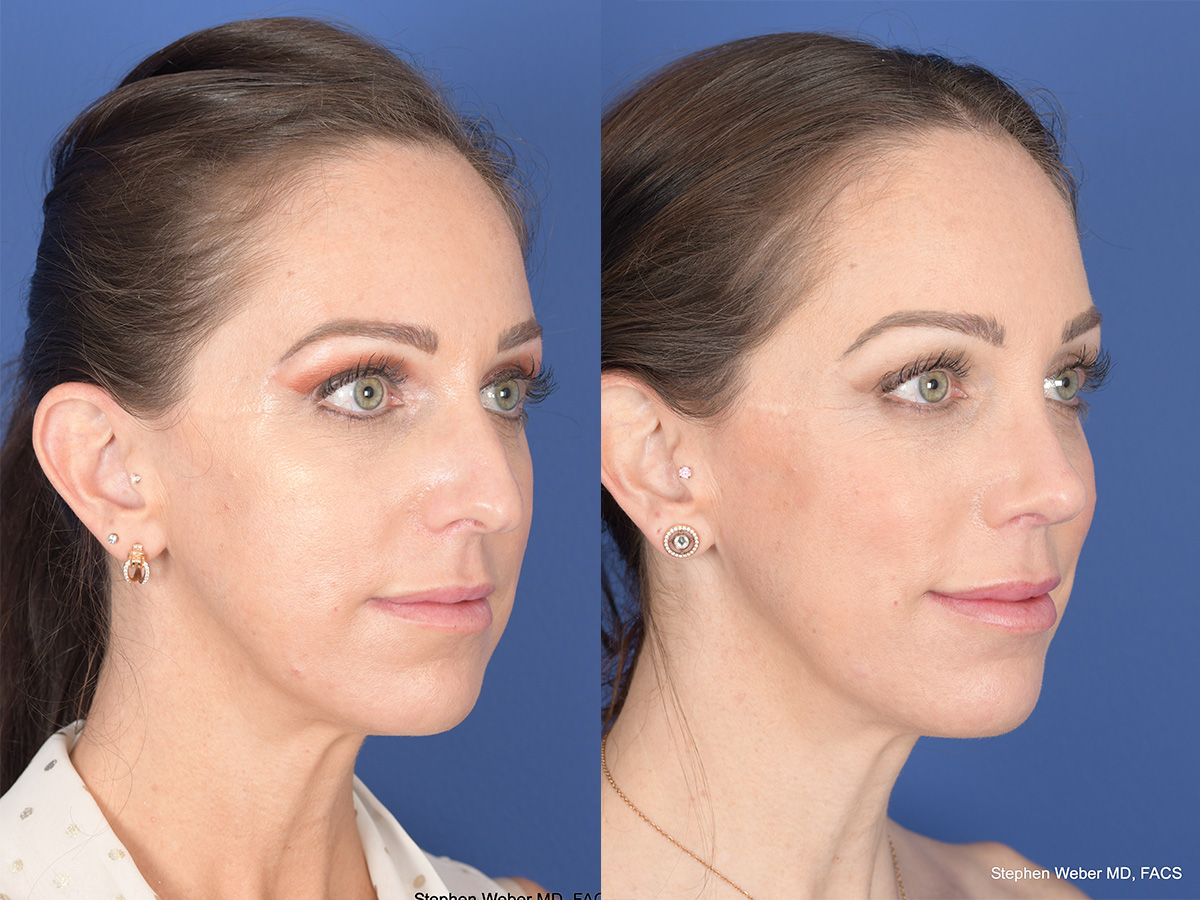 Rhinoplasty Before and After | Weber Facial Plastic Surgery