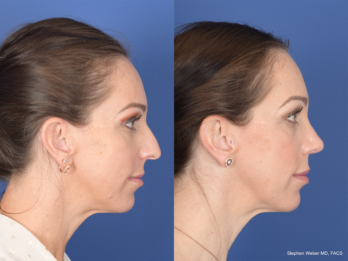 Rhinoplasty Before and After | Weber Facial Plastic Surgery