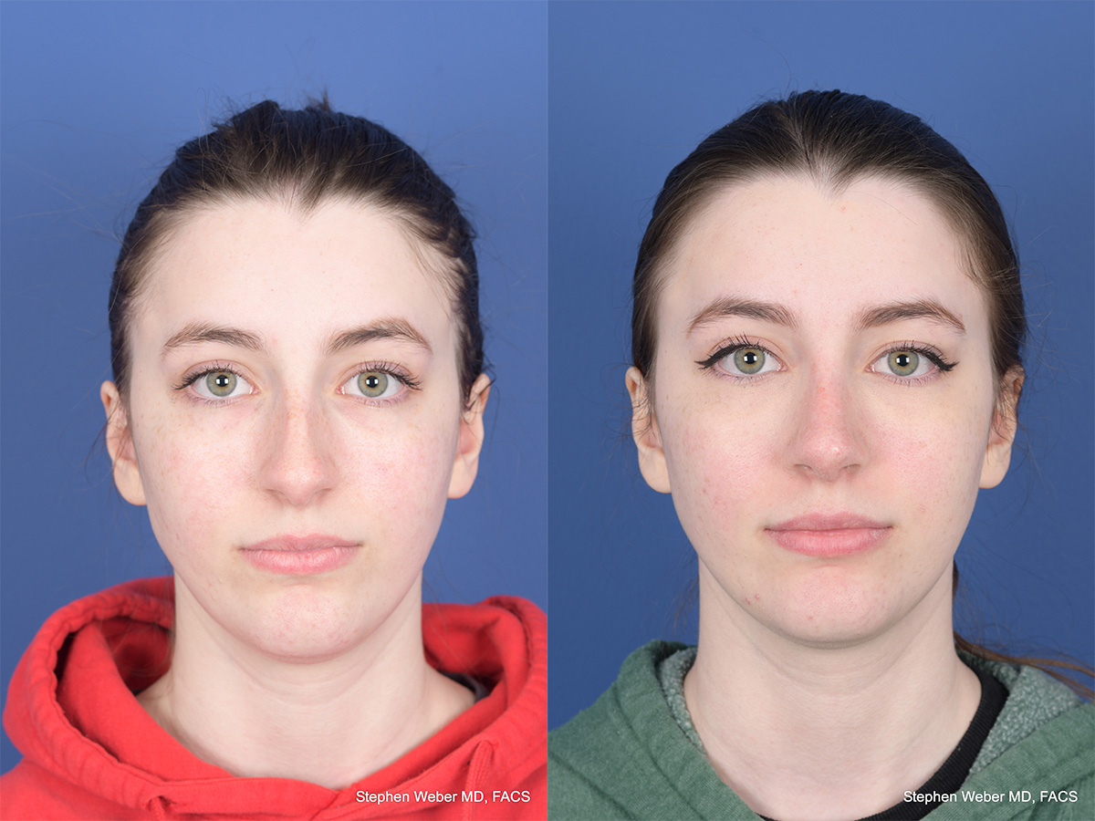 Rhinoplasty Before and After | Weber Facial Plastic Surgery