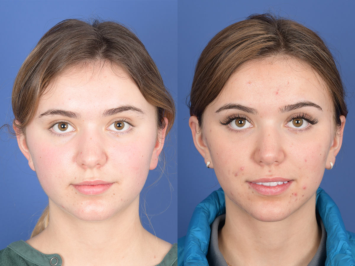 Rhinoplasty Before and After | Weber Facial Plastic Surgery