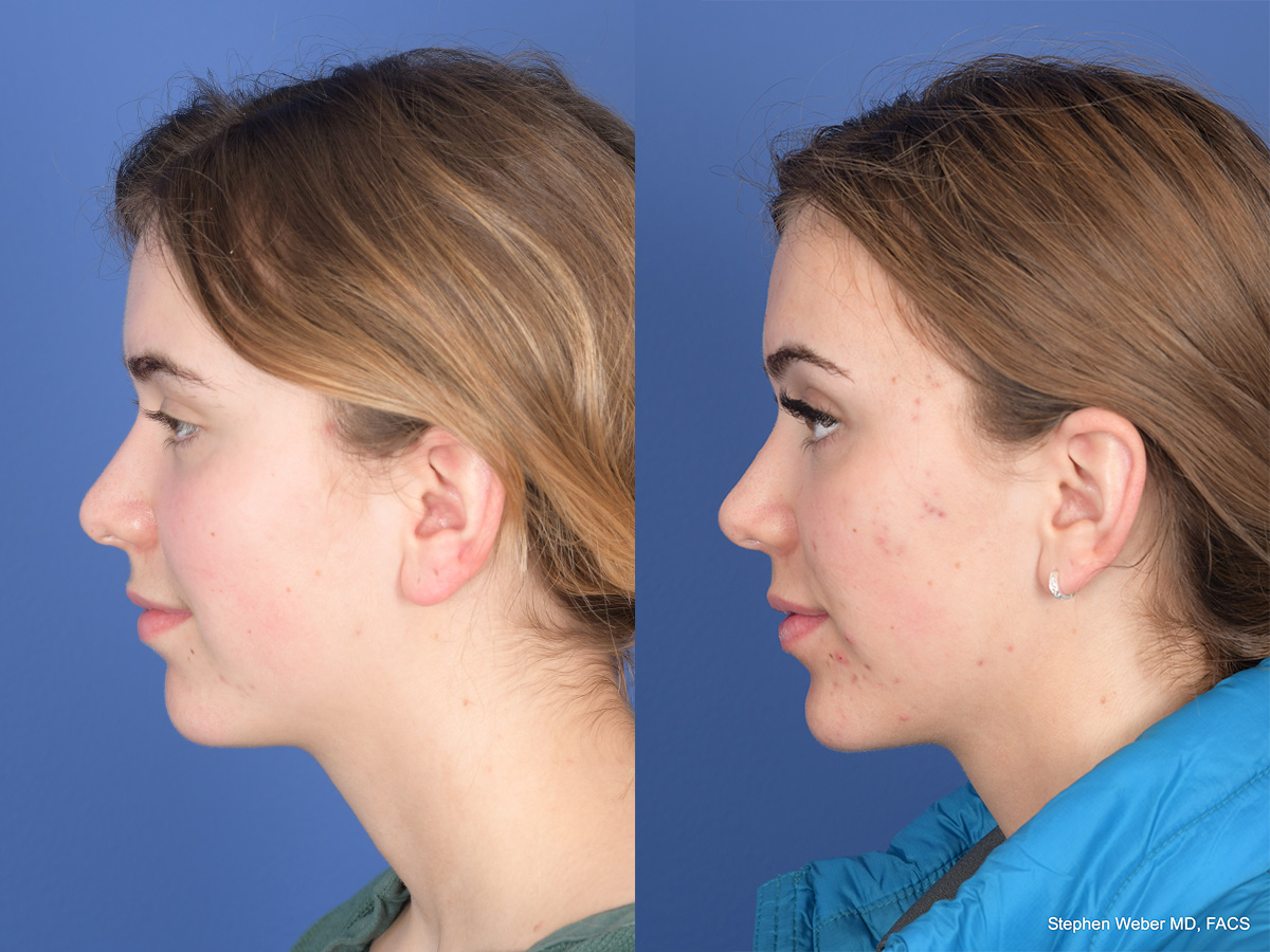 Rhinoplasty Before and After | Weber Facial Plastic Surgery