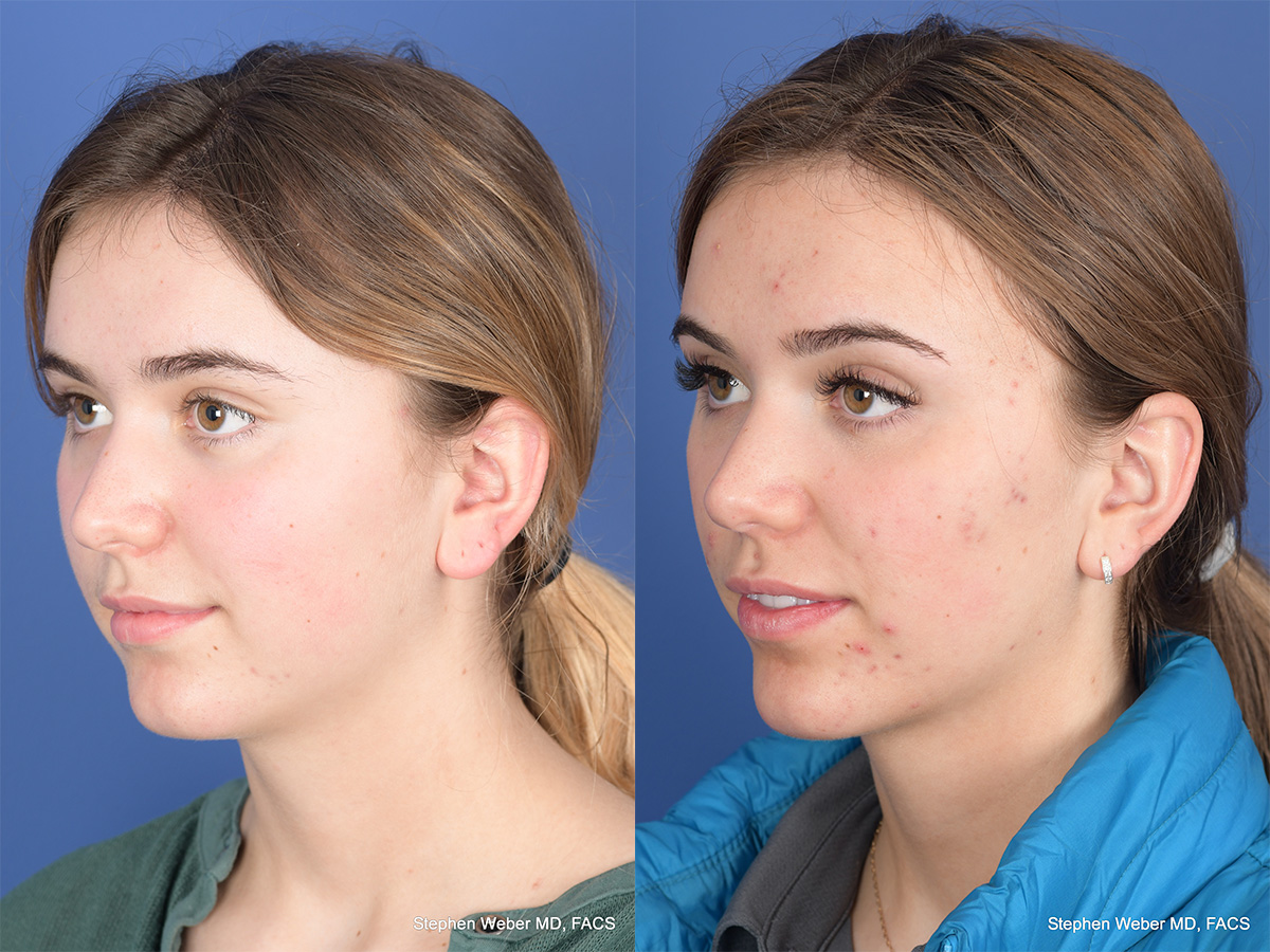 Rhinoplasty Before and After | Weber Facial Plastic Surgery